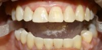 Cosmetic Bonding After