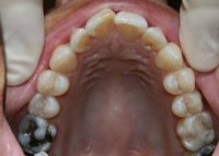 Invisalign Upper Arch Before