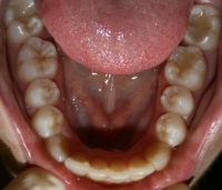 Invisalign Lower Arch After