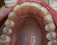 Invisalign Upper After