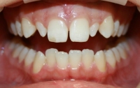 Porcelain Veneers Before