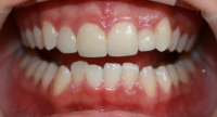 Porcelain Veneers After